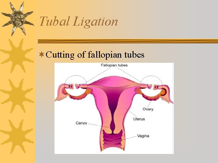 Tubal Ligation ¬Cutting of fallopian tubes 