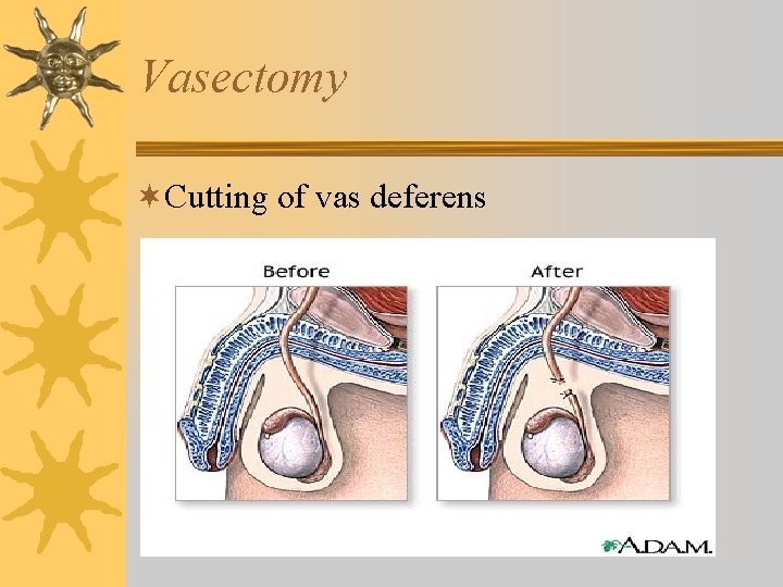 Vasectomy ¬Cutting of vas deferens 