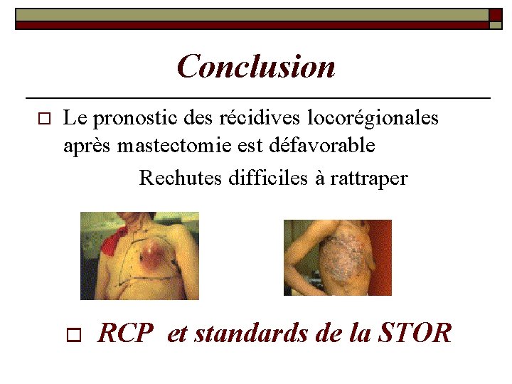 Conclusion o Le pronostic des récidives locorégionales après mastectomie est défavorable Rechutes difficiles à Conclusion o Le pronostic des récidives locorégionales après mastectomie est défavorable Rechutes difficiles à