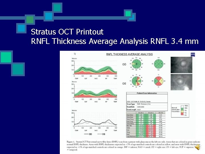 Stratus OCT Printout RNFL Thickness Average Analysis RNFL 3. 4 mm 