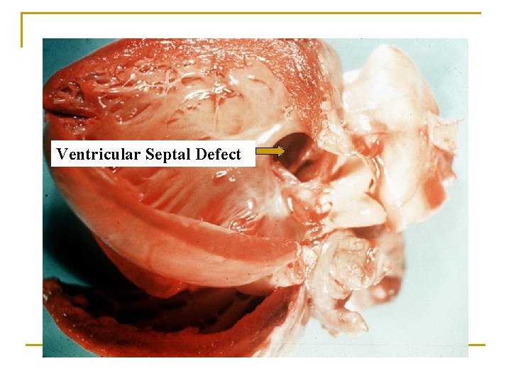 Ventricular Septal Defect 