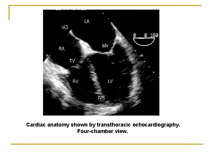Cardiac anatomy shown by transthoracic echocardiography. Four-chamber view. 