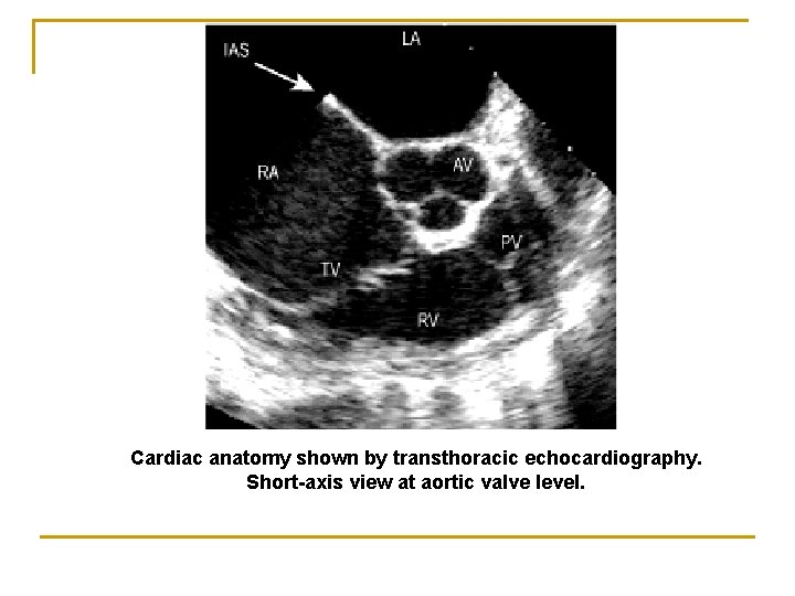 Cardiac anatomy shown by transthoracic echocardiography. Short-axis view at aortic valve level. 