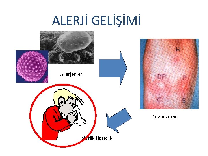 ALERJİ GELİŞİMİ Allerjenler Duyarlanma alerjik Hastalık 