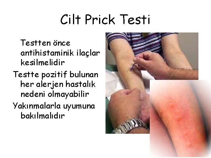 Cilt Prick Testi Testten önce antihistaminik ilaçlar kesilmelidir Testte pozitif bulunan her alerjen hastalık