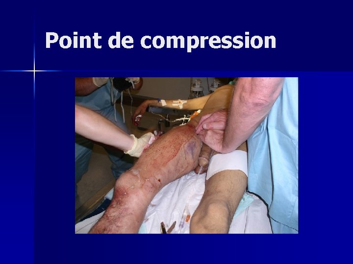 Point de compression 