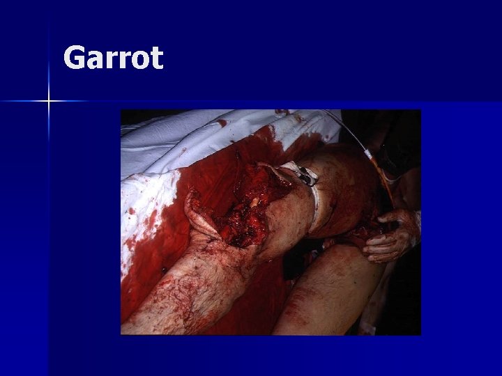 Garrot 