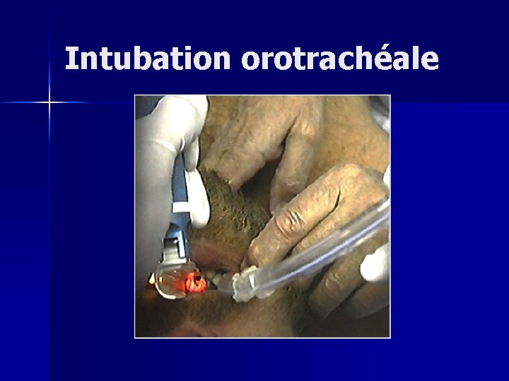 Intubation orotrachéale 