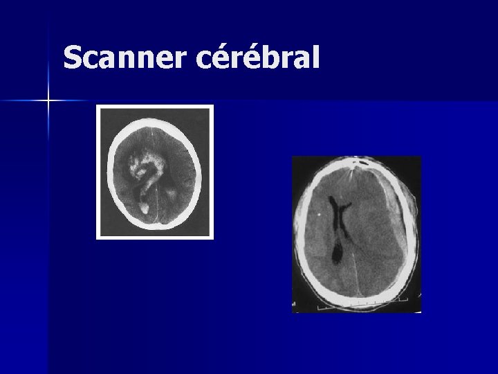 Scanner cérébral 