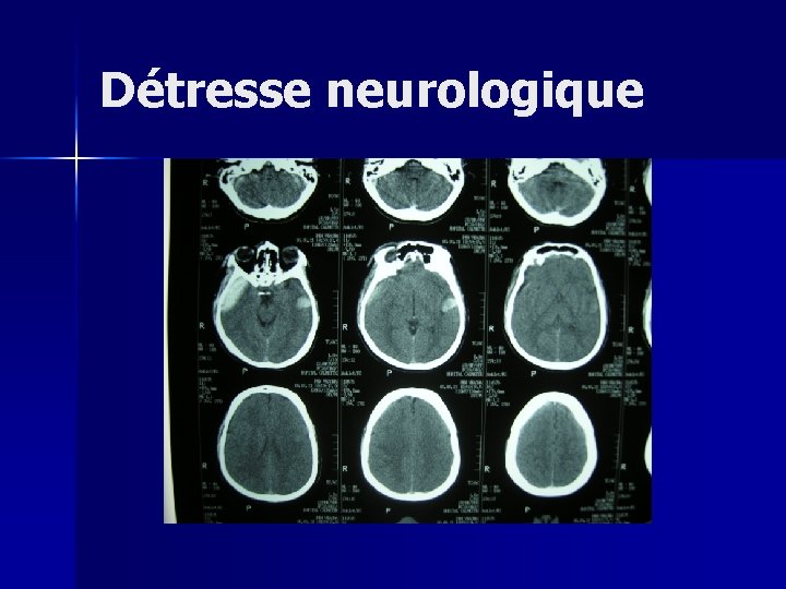 Détresse neurologique 