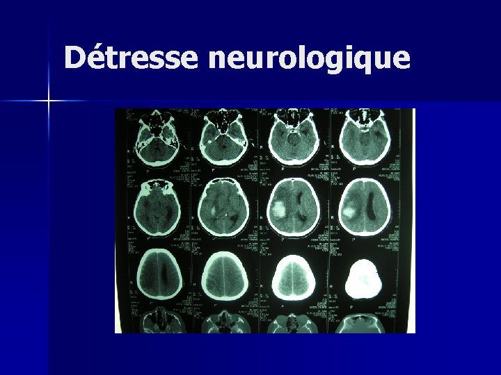 Détresse neurologique 