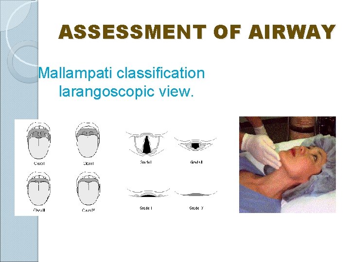 ASSESSMENT OF AIRWAY Mallampati classification larangoscopic view. 