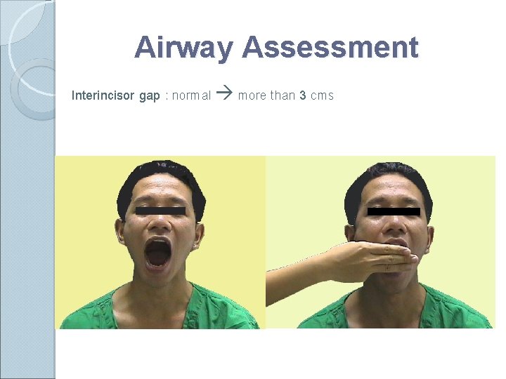 Airway Assessment Interincisor gap : normal more than 3 cms 