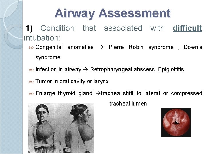 Airway Assessment 1) Condition intubation: that associated with difficult Congenital anomalies Pierre Robin syndrome