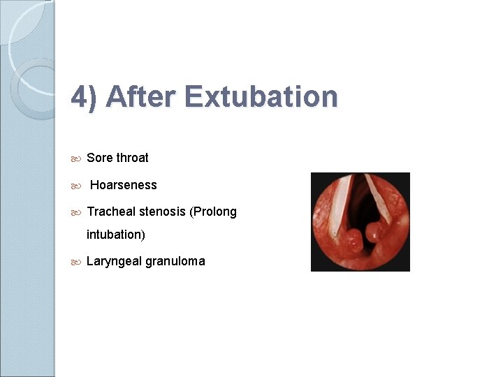 4) After Extubation Sore throat Hoarseness Tracheal stenosis (Prolong intubation) Laryngeal granuloma 