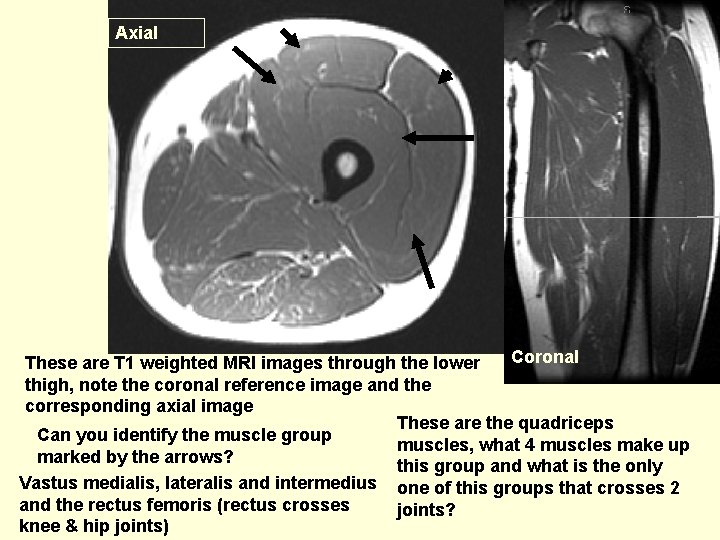 Axial Coronal These are T 1 weighted MRI images through the lower thigh, note