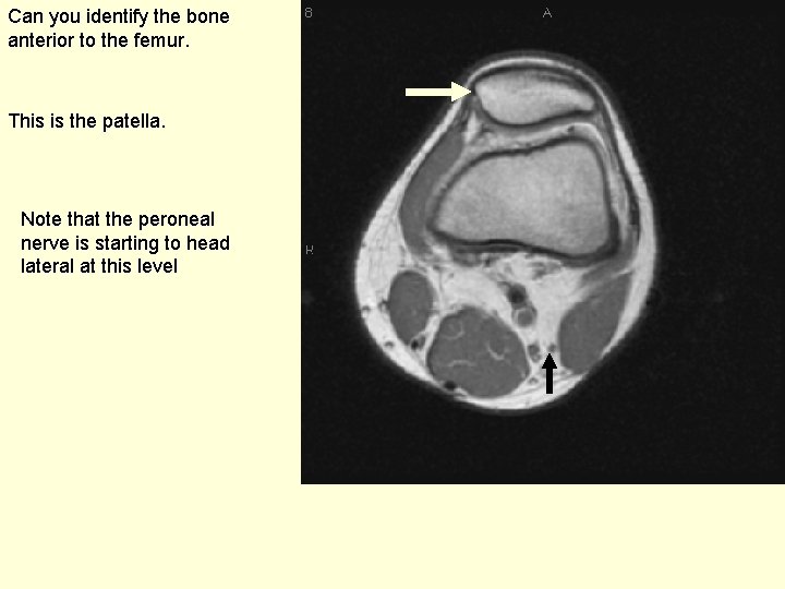 Can you identify the bone anterior to the femur. This is the patella. Note