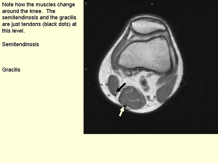 Note how the muscles change around the knee. The semitendinosis and the gracilis are