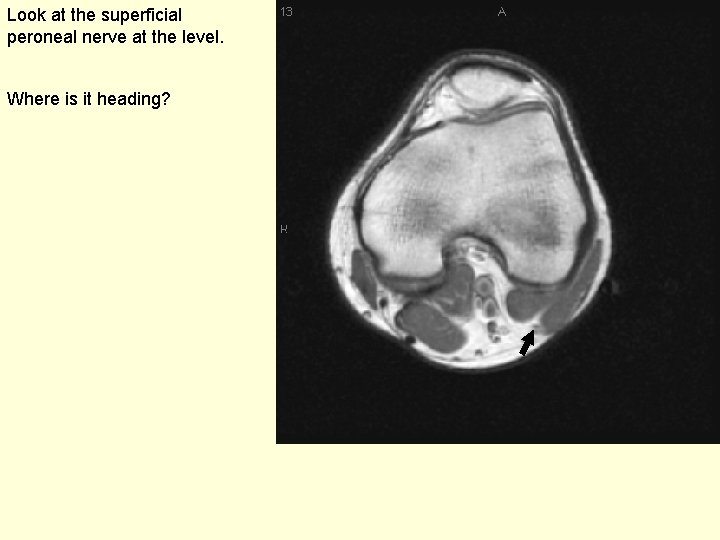 Look at the superficial peroneal nerve at the level. Where is it heading? 