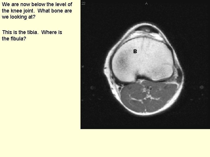 We are now below the level of the knee joint. What bone are we