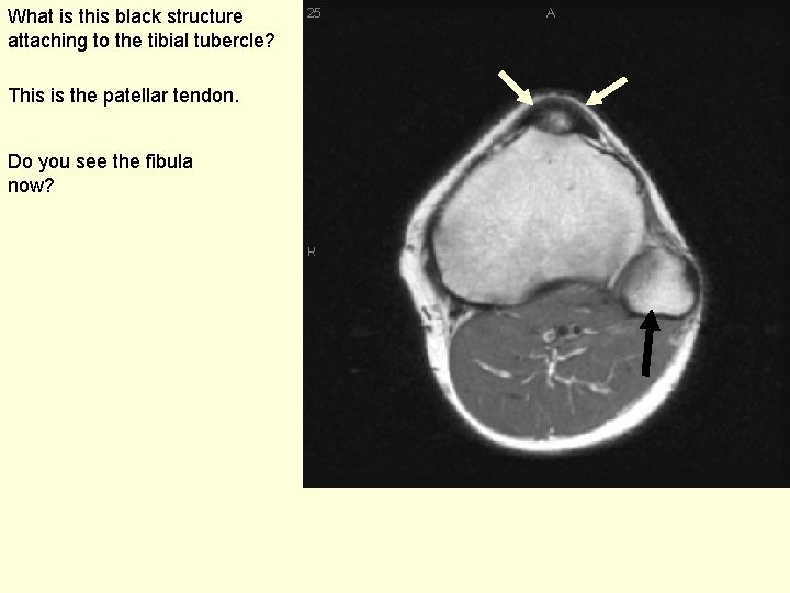 What is this black structure attaching to the tibial tubercle? This is the patellar