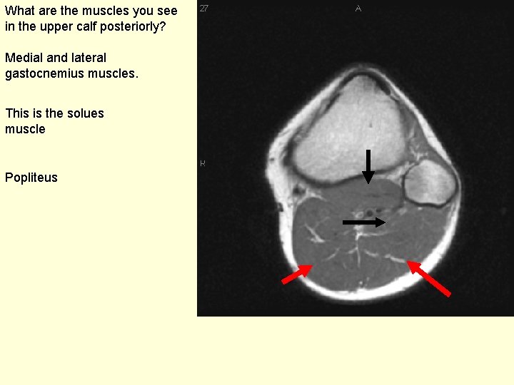 What are the muscles you see in the upper calf posteriorly? Medial and lateral