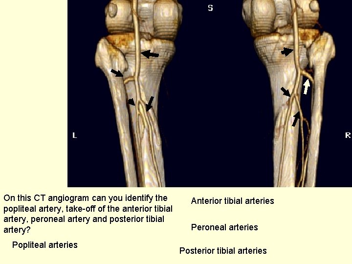 On this CT angiogram can you identify the popliteal artery, take-off of the anterior