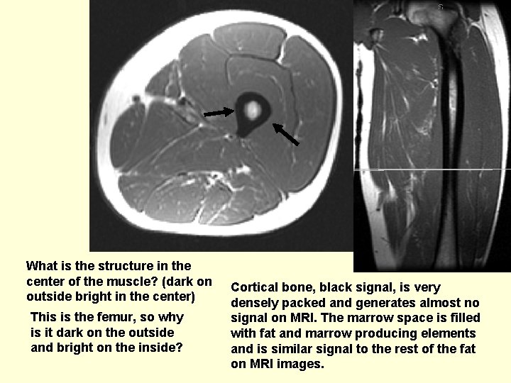 What is the structure in the center of the muscle? (dark on outside bright