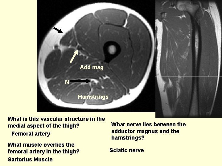 Add mag N Hamstrings What is this vascular structure in the medial aspect of