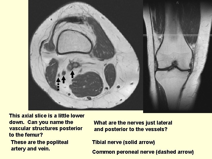 This axial slice is a little lower down. Can you name the vascular structures