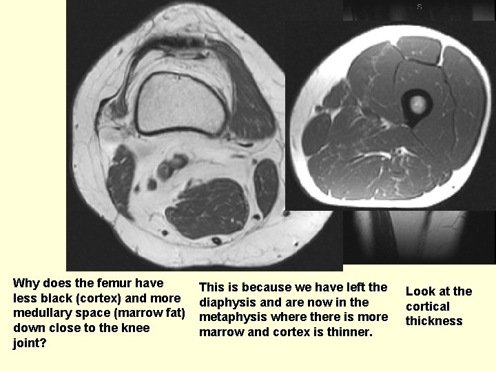 Why does the femur have less black (cortex) and more medullary space (marrow fat)