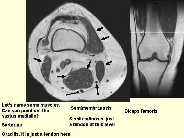 Let’s name some muscles. Can you point out the vastus medialis? Sartorius Semimembranosis Semitendinosis,