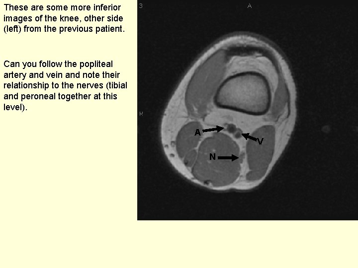 These are some more inferior images of the knee, other side (left) from the