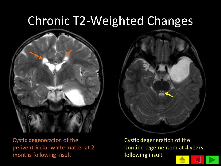 Chronic T 2 -Weighted Changes Cystic degeneration of the periventricular white matter at 2