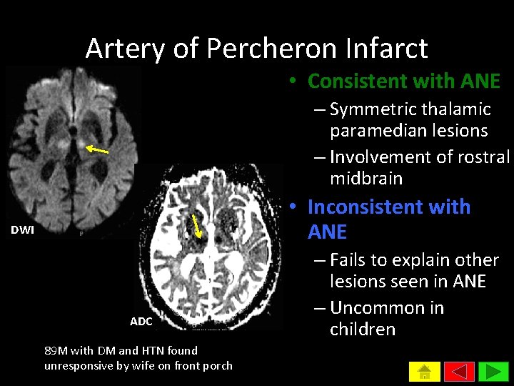 Artery of Percheron Infarct • Consistent with ANE – Symmetric thalamic paramedian lesions –