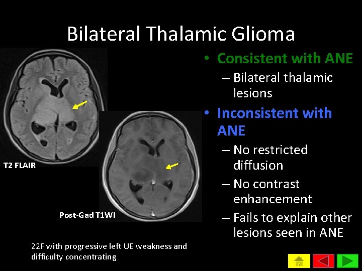Bilateral Thalamic Glioma • Consistent with ANE – Bilateral thalamic lesions • Inconsistent with