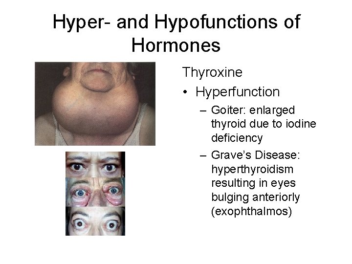 Hyper- and Hypofunctions of Hormones Thyroxine • Hyperfunction – Goiter: enlarged thyroid due to