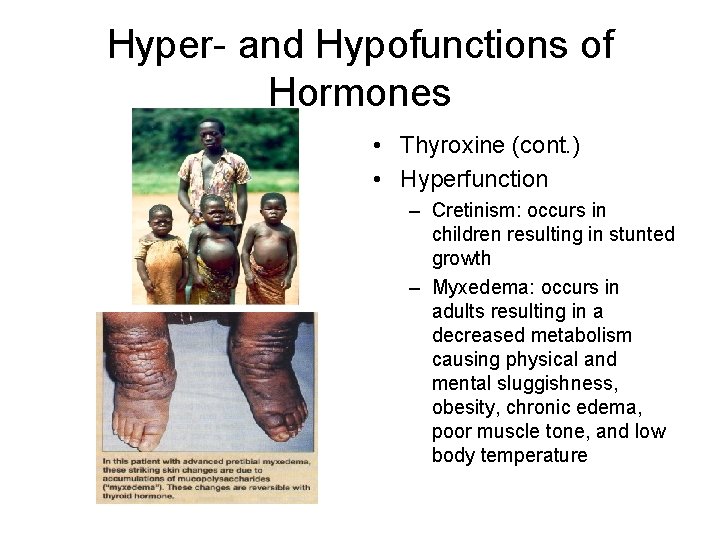 Hyper- and Hypofunctions of Hormones • Thyroxine (cont. ) • Hyperfunction – Cretinism: occurs