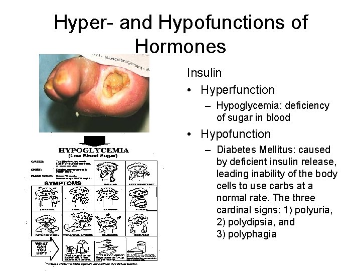 Hyper- and Hypofunctions of Hormones Insulin • Hyperfunction – Hypoglycemia: deficiency of sugar in