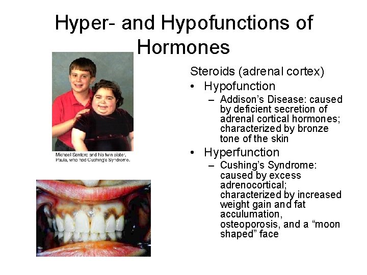 Hyper- and Hypofunctions of Hormones Steroids (adrenal cortex) • Hypofunction – Addison’s Disease: caused