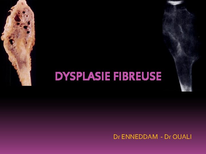 DYSPLASIE FIBREUSE Dr ENNEDDAM - Dr OUALI 