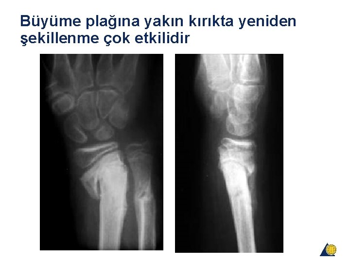 Büyüme plağına yakın kırıkta yeniden şekillenme çok etkilidir Büyüme plağına yakın kırıkta yeniden şekillenme çok etkilidir