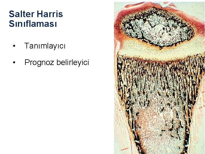 Salter Harris Sınıflaması • Tanımlayıcı • Prognoz belirleyici Salter Harris Sınıflaması • Tanımlayıcı • Prognoz belirleyici