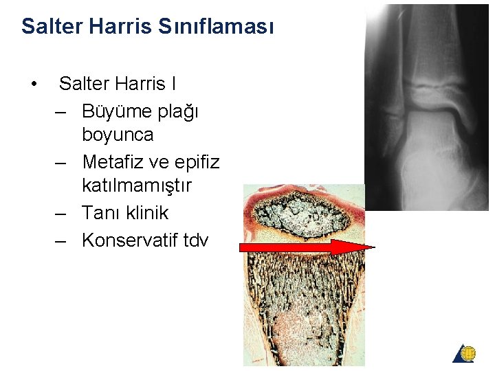 Salter Harris Sınıflaması • Salter Harris I – Büyüme plağı boyunca – Metafiz ve Salter Harris Sınıflaması • Salter Harris I – Büyüme plağı boyunca – Metafiz ve