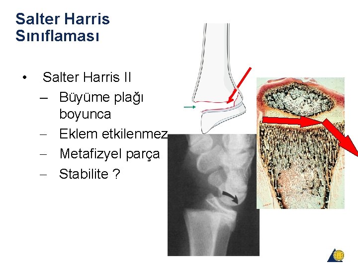 Salter Harris Sınıflaması • Salter Harris II – Büyüme plağı boyunca - Eklem etkilenmez Salter Harris Sınıflaması • Salter Harris II – Büyüme plağı boyunca - Eklem etkilenmez