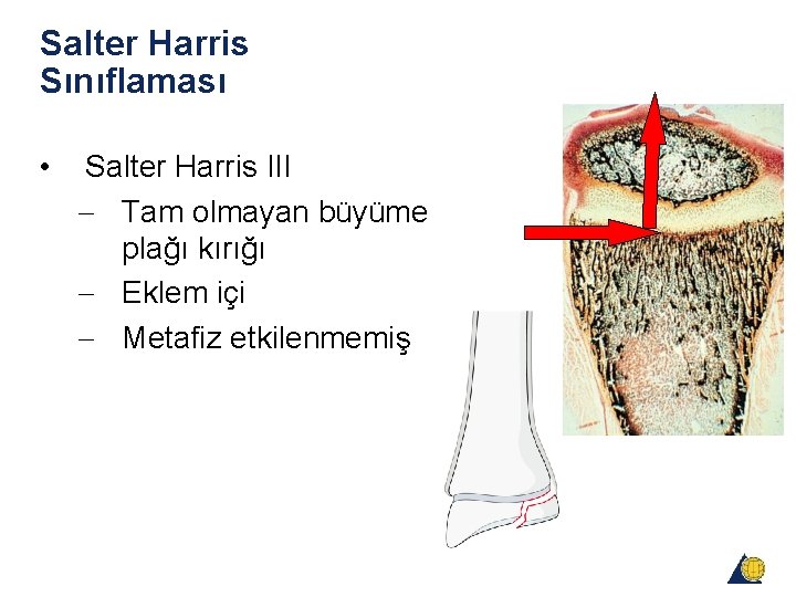 Salter Harris Sınıflaması • Salter Harris III - Tam olmayan büyüme plağı kırığı - Salter Harris Sınıflaması • Salter Harris III - Tam olmayan büyüme plağı kırığı -