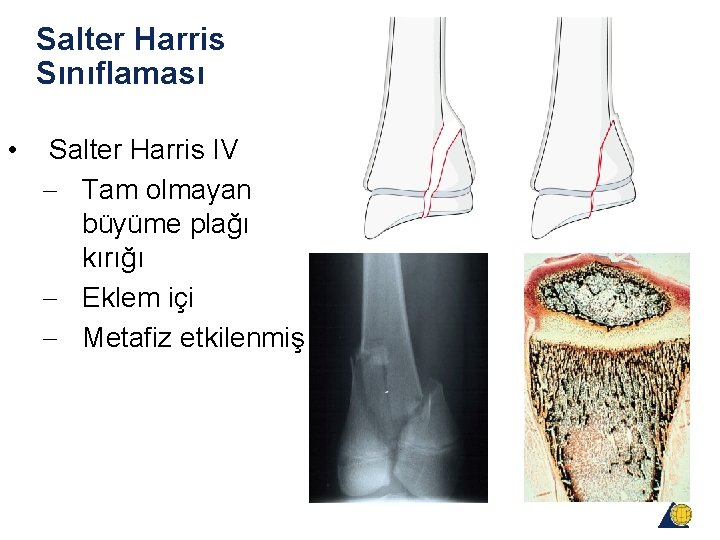 Salter Harris Sınıflaması • Salter Harris IV - Tam olmayan büyüme plağı kırığı - Salter Harris Sınıflaması • Salter Harris IV - Tam olmayan büyüme plağı kırığı -