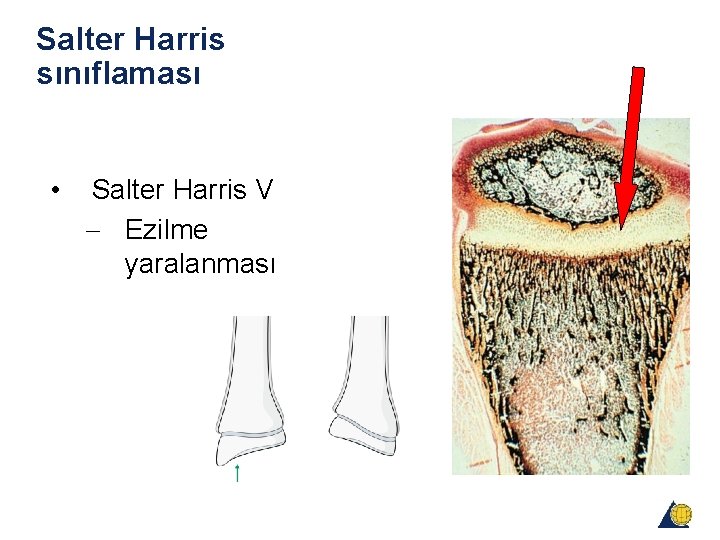 Salter Harris sınıflaması • Salter Harris V - Ezilme yaralanması Salter Harris sınıflaması • Salter Harris V - Ezilme yaralanması