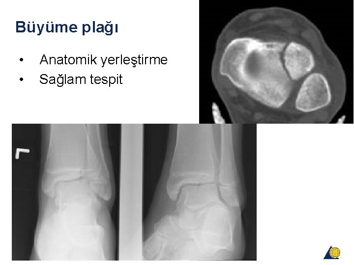 Büyüme plağı • • Anatomik yerleştirme Sağlam tespit Büyüme plağı • • Anatomik yerleştirme Sağlam tespit