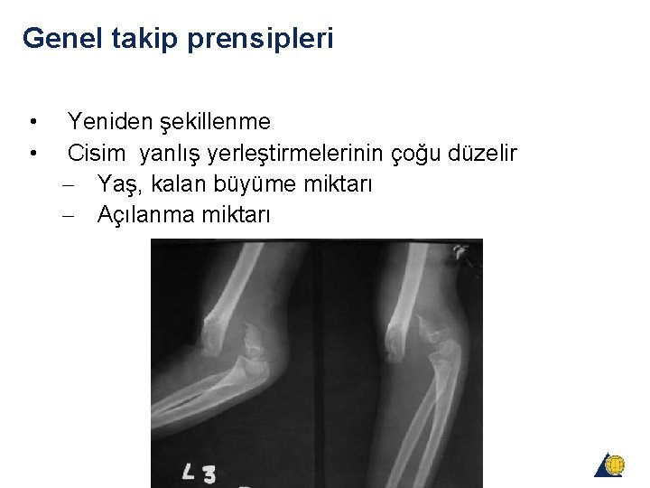 Genel takip prensipleri • • Yeniden şekillenme Cisim yanlış yerleştirmelerinin çoğu düzelir - Yaş, Genel takip prensipleri • • Yeniden şekillenme Cisim yanlış yerleştirmelerinin çoğu düzelir - Yaş,